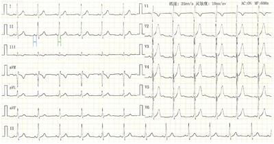 Case Report: An Unusual Case of Fasciculoventricular Pathway